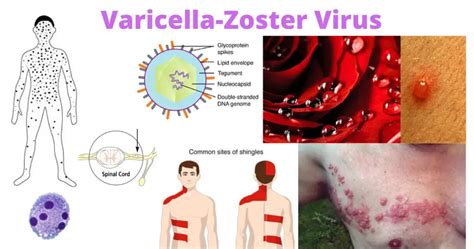 Varicella-Zoster Virus (VZV): Chicken Pox and Shingles – Microbe Online