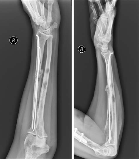 Woman, 62 years old, right forearm x-ray in aP and lateral projection ...