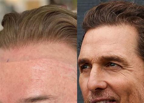 Matthew McConaughey Hair Loss Secrets Revealed!