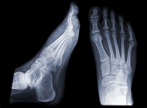 Anatomy Of Foot Bones X Ray - Metatarsal Stress Fracture | Bocgaswasuas