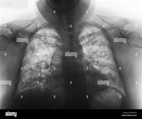 Abnormal chest x-ray showing pneumonia in a 27 year old female with influenza Stock Photo - Alamy