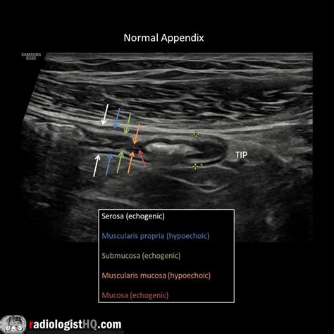 Normal appendix on ultrasound : r/Radiology