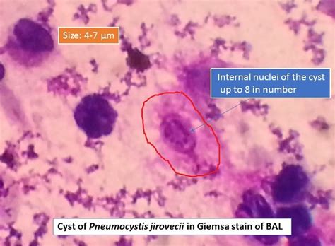 Pneumocystis jirovecii in Giemsa stain and its details