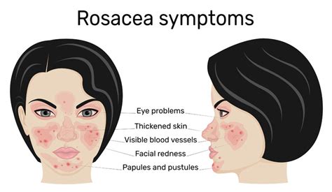 Understanding Two Types Of Rosacea: Skin and the Eyes