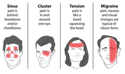 Migraine Relief Pressure Points