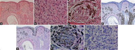 Melanoma arising from the epidermis overlying an acquired intradermal ...