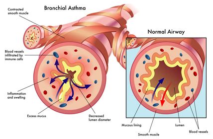 Information on Asthma | Asthma Resources and Helpful Tips