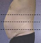 Curve Lipo Laser Results Gallery – YOLO Medical Inc.