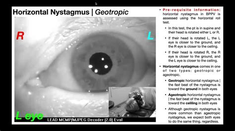 Nystagmus EXPLAINED 👀 | Visualizing & Interpretation - YouTube