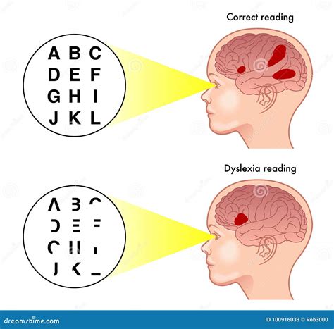 Symptômes de dyslexie illustration de vecteur. Illustration du ...