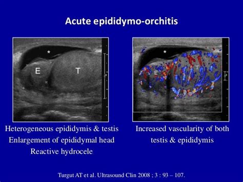 Doppler ultrasound of acute scrotum