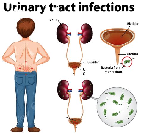 Informative Illustration Of Urinary Tract Infections Pain Unwell Infections Vector, Pain, Unwell ...