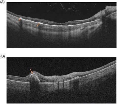 Dalen-Fuchs nodules type 2 (A) and type 3 (B) on optical coherence ...