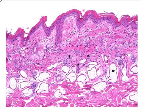 Calf 1 skin histology at day of presentation: Superficial laminar ...