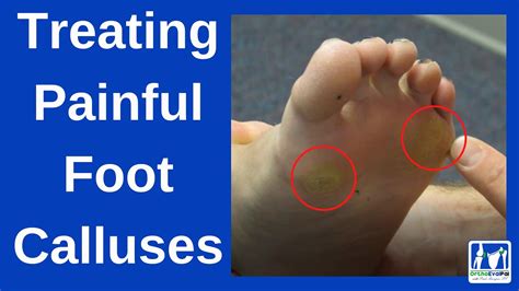 How To Cure A Calluses On Your Foot Sale | emergencydentistry.com