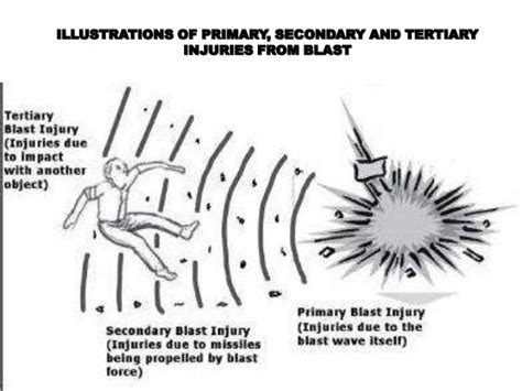 Blast injuries