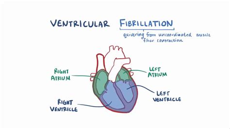 Ventricular fibrillation: Video, Anatomy & Definition | Osmosis