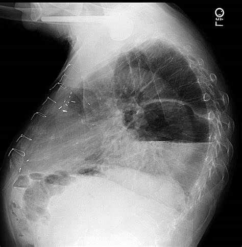 Gastric volvulus - wikidoc