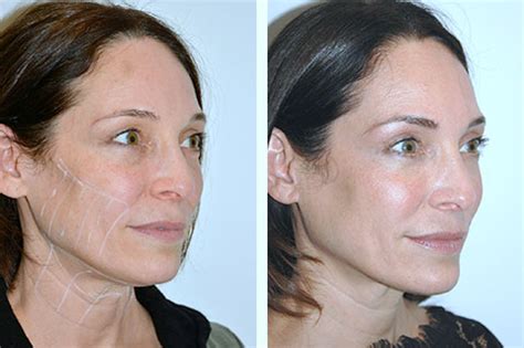 Non-Surgical Facelift | Non-Surgical Face Lift NYC