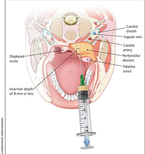 peritonsillar abscess | Liver warning signs, Intravenous therapy, Healthy advice