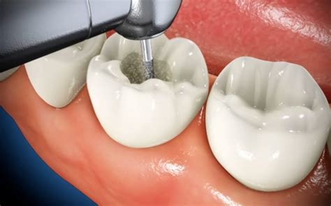 How an Endodontist Can Save You With Tooth-saving Root Canal Procedure | West Cobb Dentistry