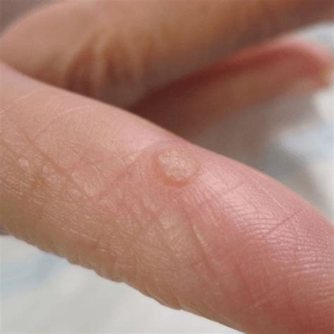 How to get rid of warts on hands and fingers - What causes warts on ...