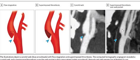 Current Understanding and Gaps in Research of Carotid Webs in Ischemic ...