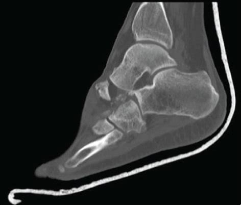 (a) 3D CT scan demonstrating swivel injury, comminuted fracture of the ...