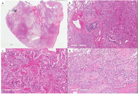 Acute Fibrinous and Organizing Pneumonia Associated With Allogenic ...