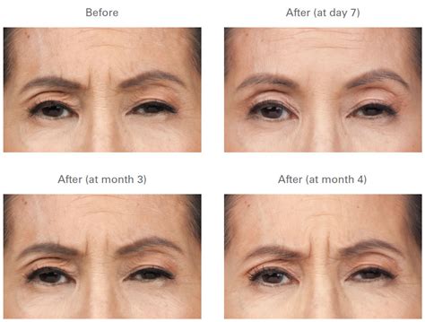 BOTOX Frown Lines - Before and After Galleries, Long Beach