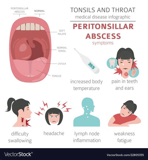 Tonsils and throat diseases peritonsillar abscess Vector Image