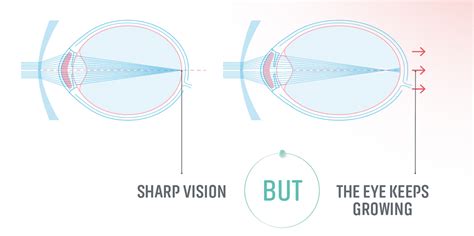 Essilor Stellest Myopia Control Lenses