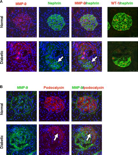 Representative confocal images of dual labeling for MMP-9 and podocyte... | Download Scientific ...