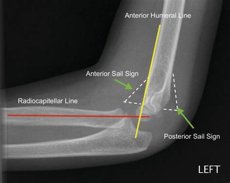 Paediatric elbow injuries - Medical Forum