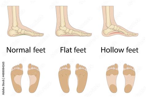 Foot deformity types, medical disease infographics. Hollow, flat, and normal foot. Vector ...