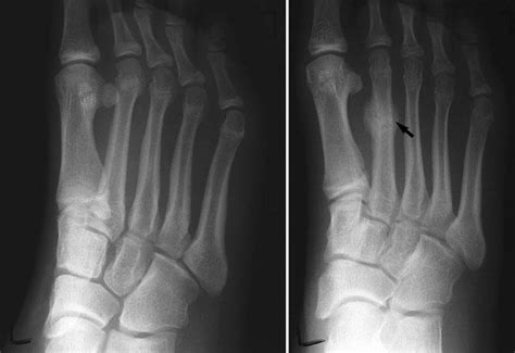 Stress Fractures of the Foot and Ankle - OrthoInfo - AAOS