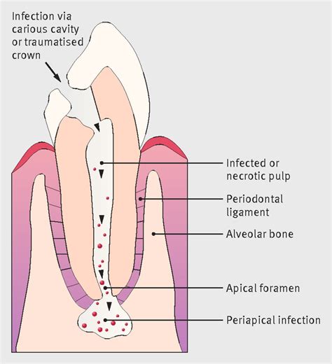 Management of severe acute dental infections | The BMJ