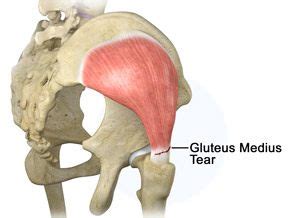 Gluteus Medius Tear Treatment Houston | Gluteus Medius Endoscopic ...