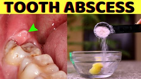 How to get rid of a tooth abscess without going to the dentist - Gum abscess treatment - YouTube