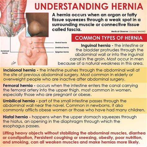 Inguinal Hernia Types Causes Symptoms Treatment Preve - vrogue.co