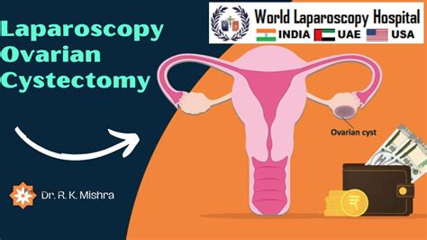 Post-operative Care After Laparoscopy Ovarian Cystectomy