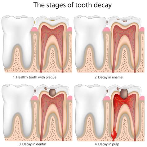 Dental Cavities (Caries) - Kids Dental - Plano & Carrollton