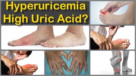 Control High Uric Acid | Signs & Symptoms | Step by Step Guide - YouTube