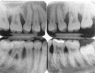 Aggressive Periodontitis - My DH Education