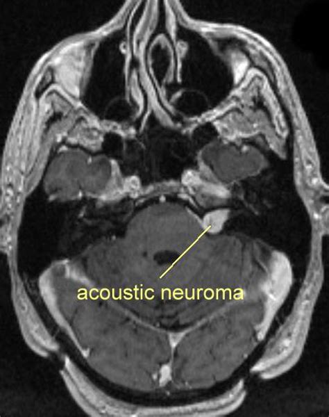 Acoustic Neuroma MRI Images