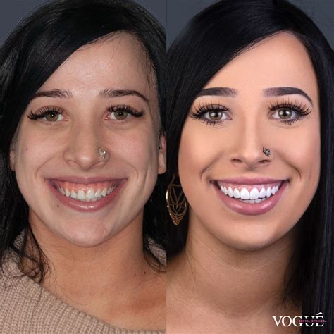 Gum Laser Surgery | Vogue Dental Studios