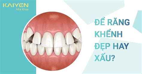 5 bộ phận của răng khểnh đẹp và cách làm cho chúng trở nên hoàn hảo