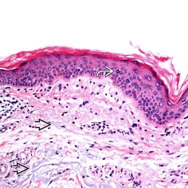 Large Cell Acanthoma | Basicmedical Key