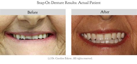 Snap-On Dentures - Dr. Eskow Prosthodontics