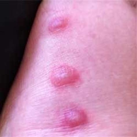 Bullous Pemphigoid | Blistering Skin Disease | HubPages